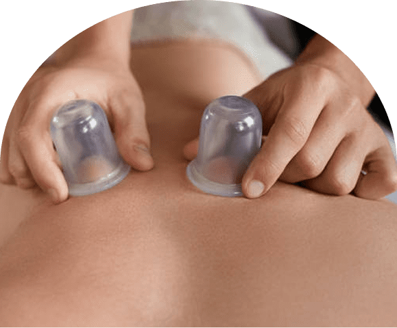 Cupping